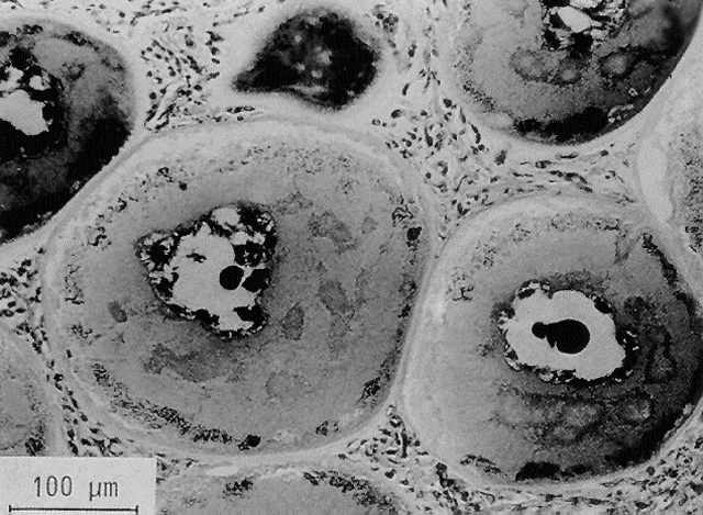 LymphoD5.gif